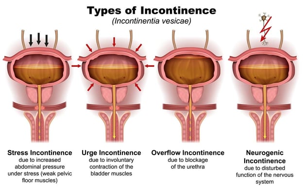 Types-of-Incontinence